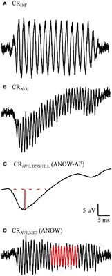 The Auditory Nerve Overlapped Waveform (ANOW) Detects Small Endolymphatic Manipulations That May Go Undetected by Conventional Measurements